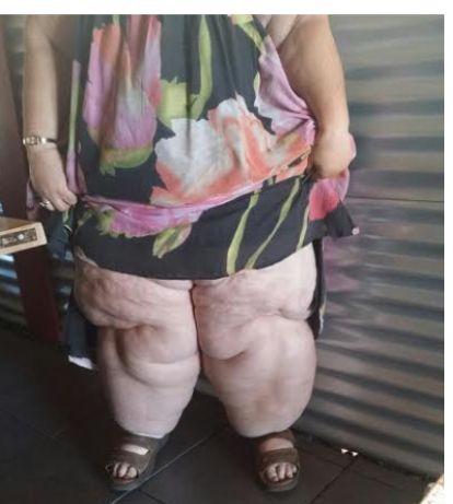 lipoedema legs